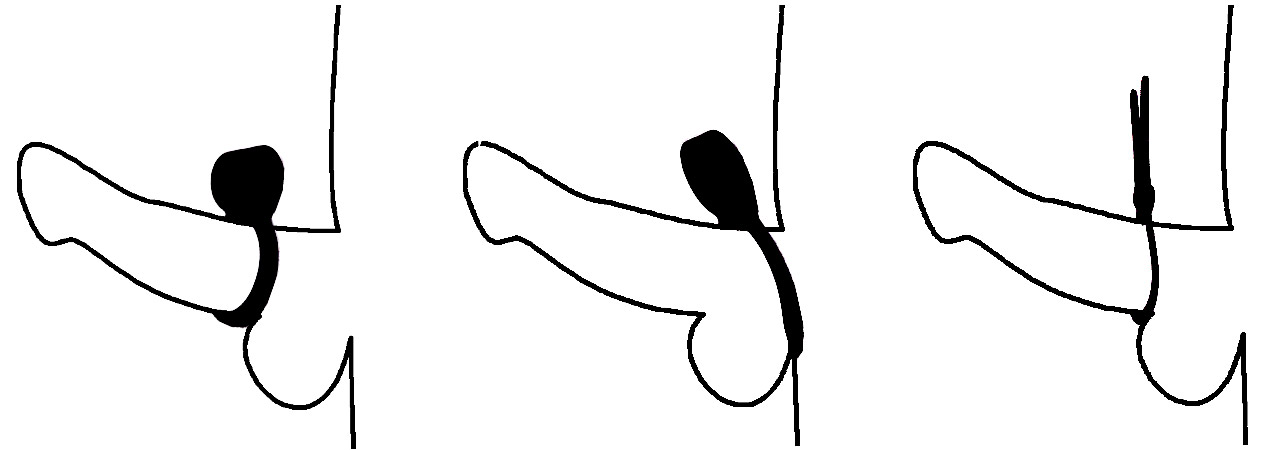Illustrations for positioning cock rings- over the shaft, over the shafts and balls and an adjustable cock ring