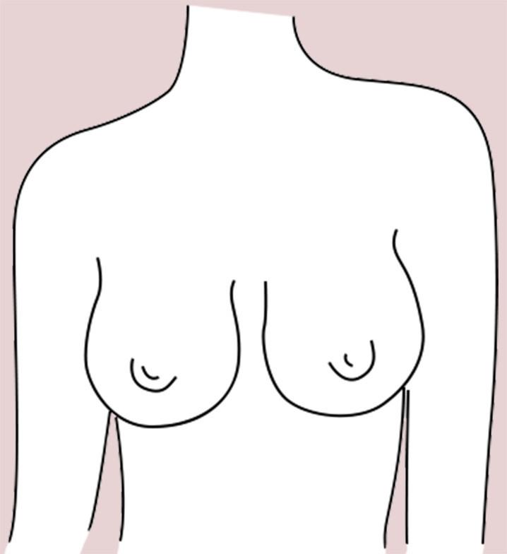 Bell-Shaped breast shape