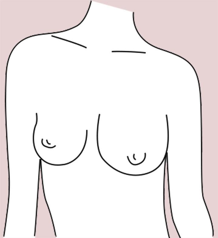 Asymmetrical breast shape