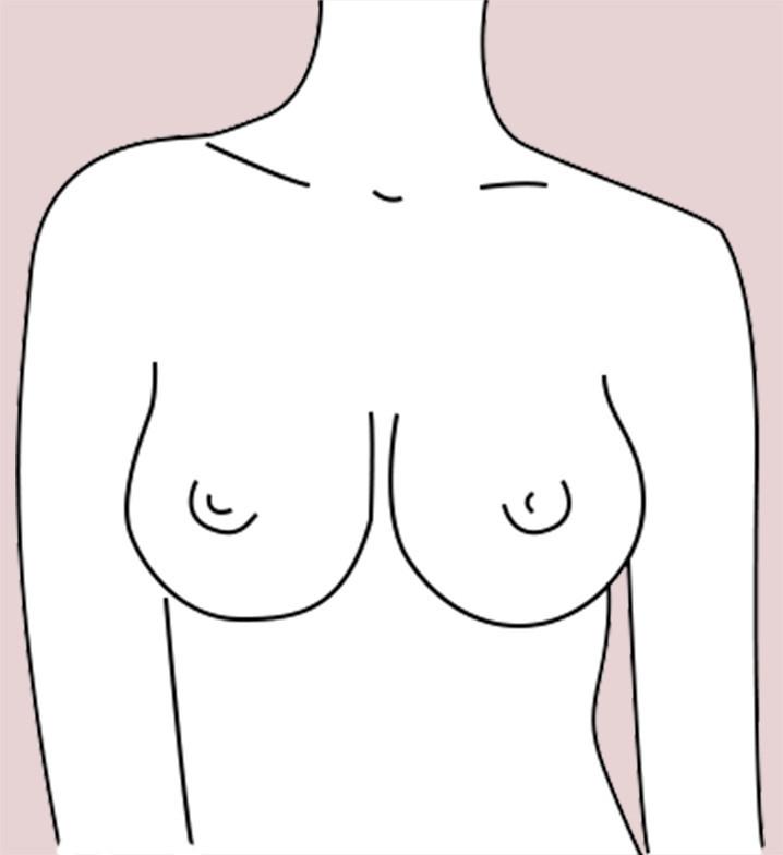 Teardrop breast shape
